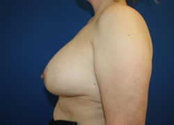 Cosmetic Breast Revision