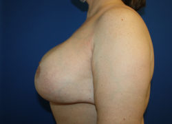 Cosmetic Breast Revision