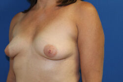 Breast Augmentation with Fat Graft