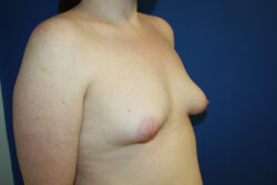 Breast Augmentation with Fat Graft