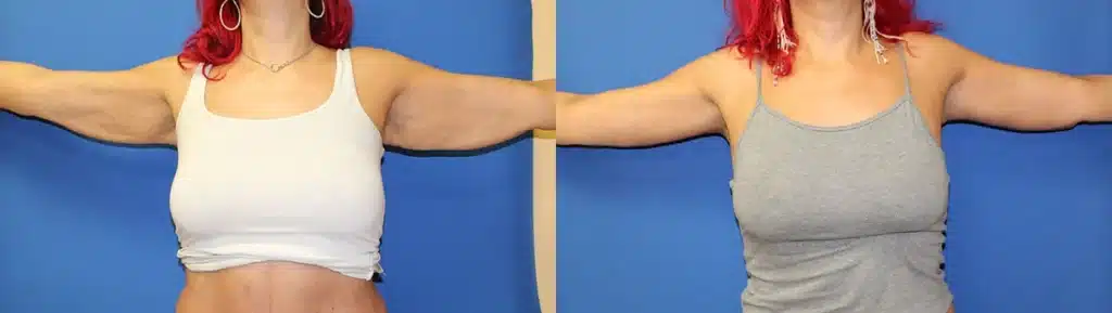 Arm Lift before and after photo by Aesthetic Plastic Surgery North Shore in Beverly, MA