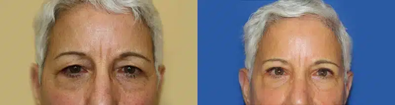 Brow Lift before and after photo by Aesthetic Plastic Surgery North Shore in Beverly, MA