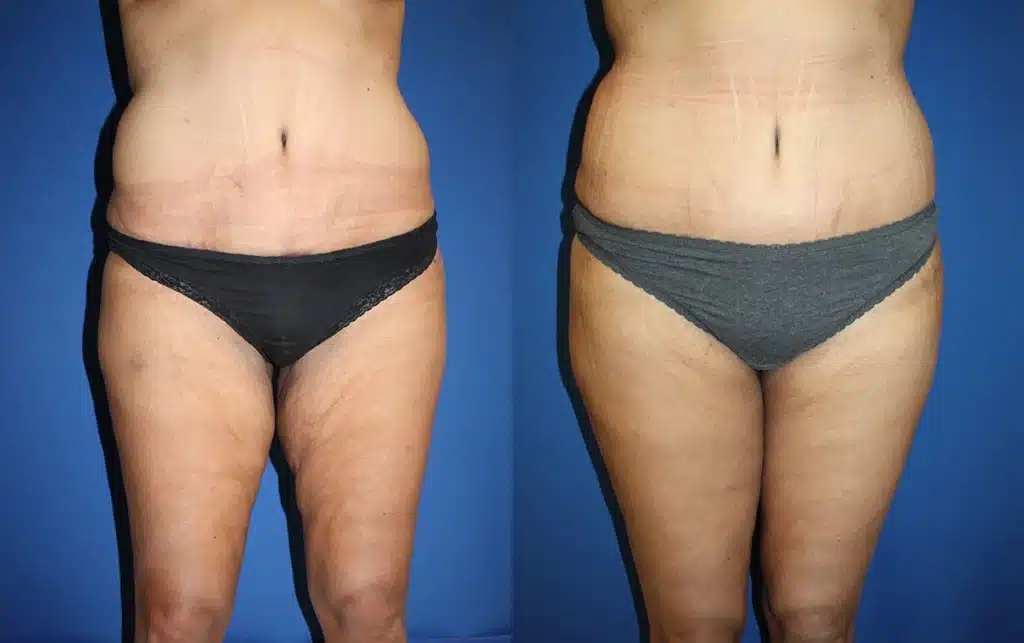 thigh lift before and after photo by aesthetic plastic surgery north shore in beverly ma