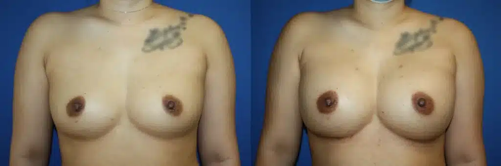 Breast Augmentation before and after photo by Aesthetic Plastic Surgery North Shore in Beverly, MA