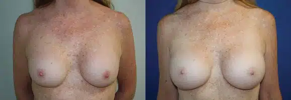 Cosmetic Breast Revision before and after photo by Aesthetic Plastic Surgery North Shore in Beverly, MA