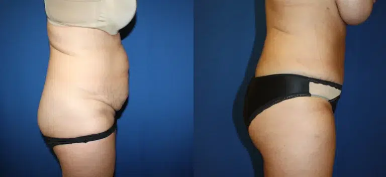 Liposuction before and after photo by Aesthetic Plastic Surgery North Shore in Beverly, MA Liposuction before and after photo by Aesthetic Plastic Surgery North Shore in Beverly, MA