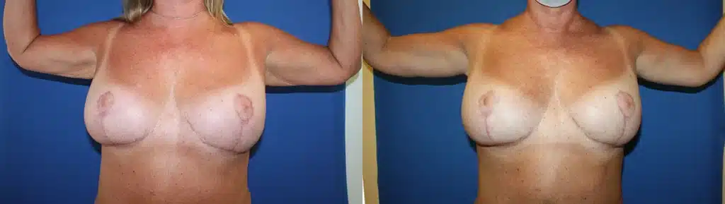 Arm Lift before and after photo by Aesthetic Plastic Surgery North Shore in Beverly, MA