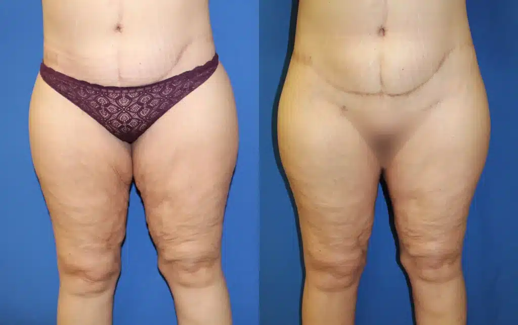 Thigh Lift before and after photo by Aesthetic Plastic Surgery North Shore in Beverly, MA