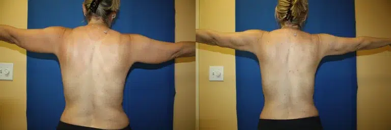 liposuction before and after photo by aesthetic plastic surgery north shore in beverly ma Liposuction before and after photo by Aesthetic Plastic Surgery North Shore in Beverly, MA