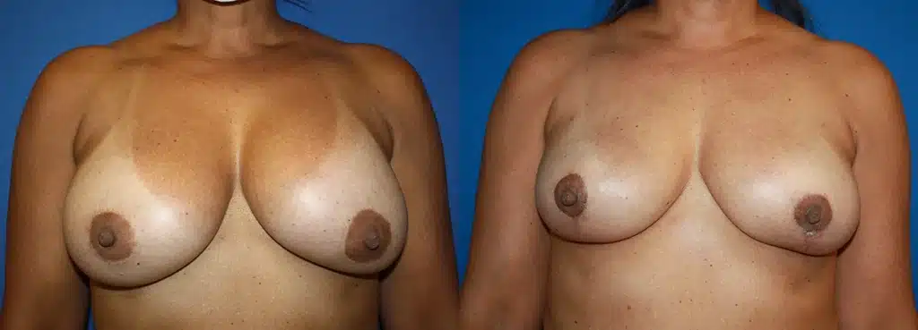 Cosmetic Breast Revision before and after photo by Aesthetic Plastic Surgery North Shore in Beverly, MA