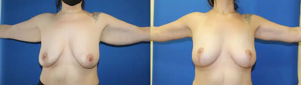 Arm Lift before and after photo by Aesthetic Plastic Surgery North Shore in Beverly, MA