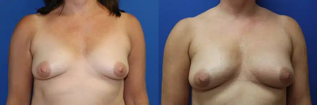 Breast Augmentation with Fat Graft before and after photo by Aesthetic Plastic Surgery North Shore in Beverly, MA