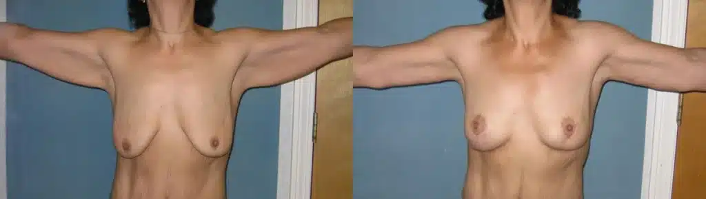 Arm Lift before and after photo by Aesthetic Plastic Surgery North Shore in Beverly, MA