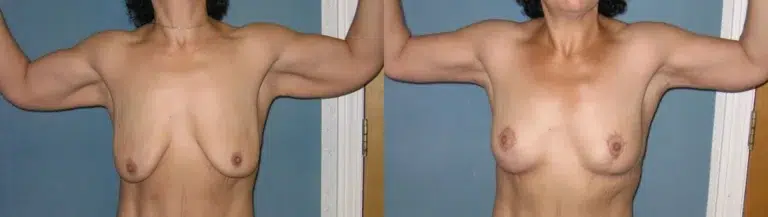 Arm Lift before and after photo by Aesthetic Plastic Surgery North Shore in Beverly, MA