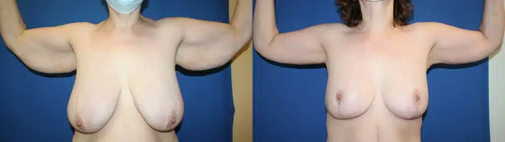 Arm Lift before and after photo by Aesthetic Plastic Surgery North Shore in Beverly, MA