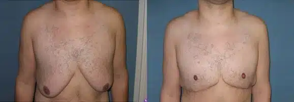 Gynecomastia before and after photo by Aesthetic Plastic Surgery North Shore in Beverly, MA
