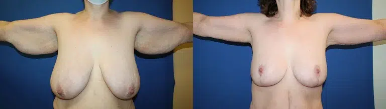 Arm Lift before and after photo by Aesthetic Plastic Surgery North Shore in Beverly, MA