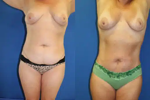 Mini Tummy Tuck (abdominoplasty) before and after photo by Aesthetic Plastic Surgery North Shore in Beverly, MA