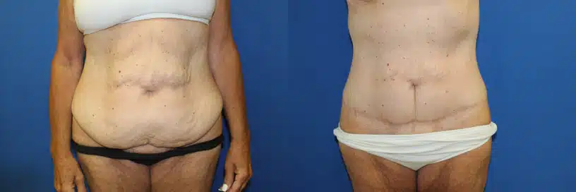 Mini Tummy Tuck (abdominoplasty) before and after photo by Aesthetic Plastic Surgery North Shore in Beverly, MA
