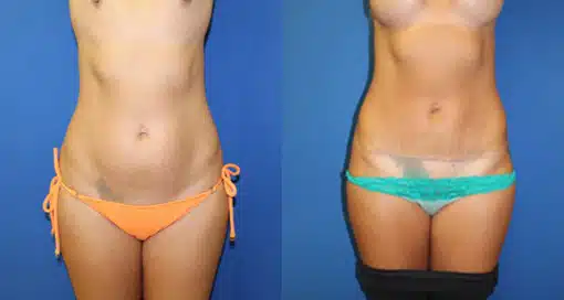 Mini Tummy Tuck (abdominoplasty) before and after photo by Aesthetic Plastic Surgery North Shore in Beverly, MA