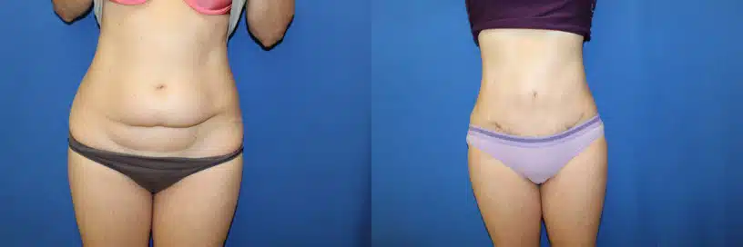 Mini Tummy Tuck (abdominoplasty) before and after photo by Aesthetic Plastic Surgery North Shore in Beverly, MA