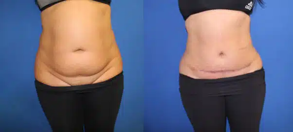 Mini Tummy Tuck (abdominoplasty) before and after photo by Aesthetic Plastic Surgery North Shore in Beverly, MA
