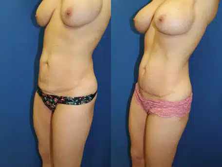 Mini Tummy Tuck (abdominoplasty) before and after photo by Aesthetic Plastic Surgery North Shore in Beverly, MA