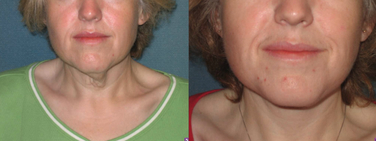 facelift before and after photo by aesthetic plastic surgery north shore in beverly ma