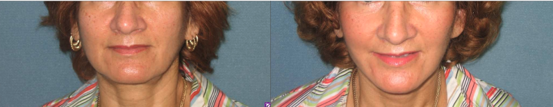 facelift before and after photo by aesthetic plastic surgery north shore in beverly ma