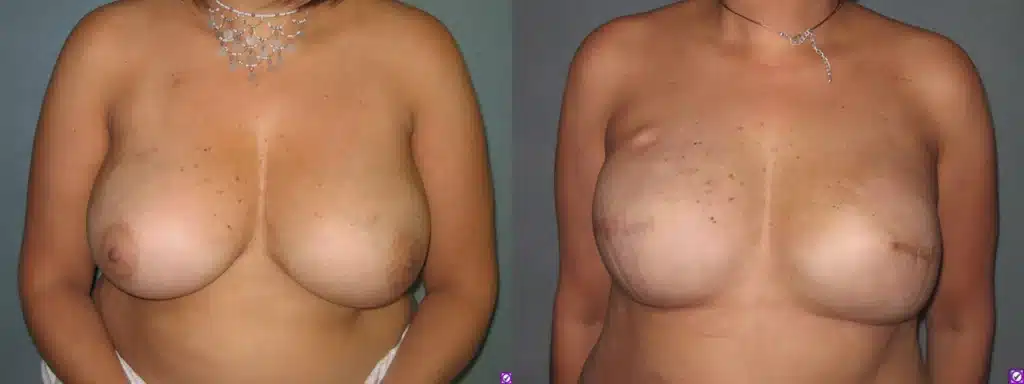 breast reconstruction before and after photo by aesthetic plastic surgery north shore in beverly ma x