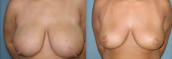 breast reduction before and after photo by aesthetic plastic surgery north shore in beverly ma