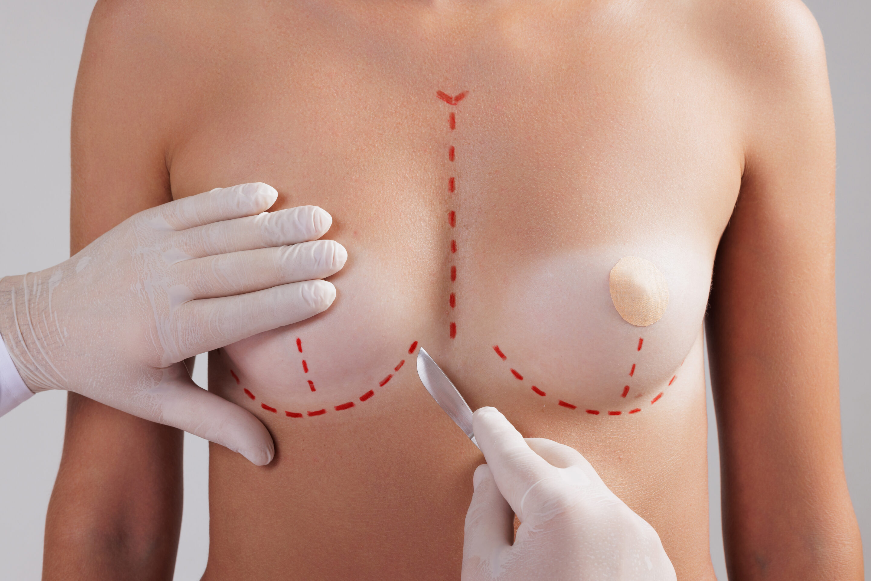 plastic surgeon holding scalpel near woman’s breast close up on white background plastic surgeon holding scalpel near woman's breast close up on white background