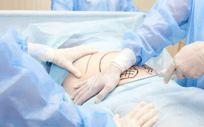 Exploring the Benefits of Liposuction for Stubborn Fat Removal