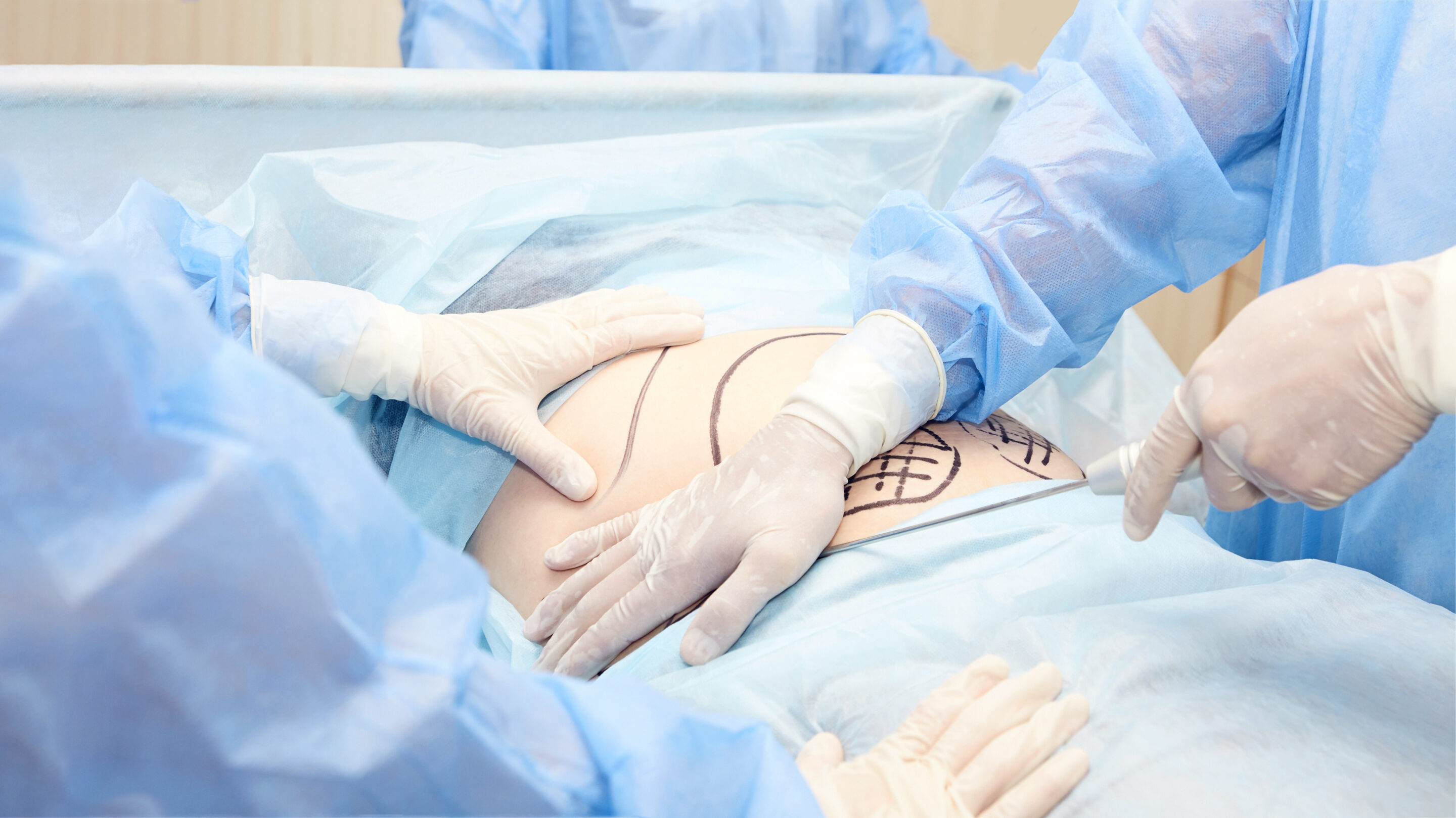 liposuction operation. Doctor hands near belly liposuction operation. Doctor hands near belly
